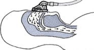 CPAP}